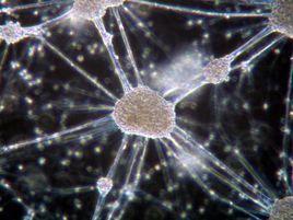 骨髓瘤管型腎病