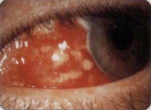 壞死性鞏膜炎 壞死性鞏膜炎