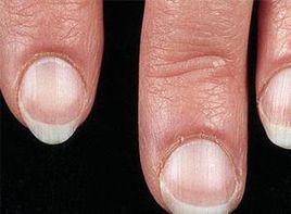 指甲末端呈直線形 指甲末端呈直線形