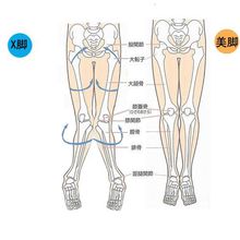 八字步後果"X型腿"