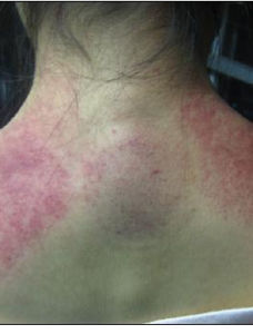 乳酸堆積 乳酸堆積