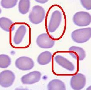 橢圓紅細胞