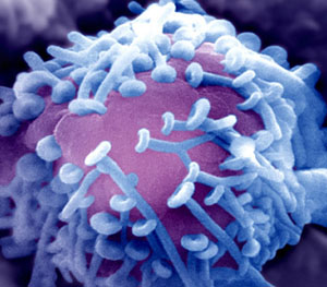 遺傳性壓力易感性周圍神經病