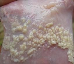 帕哲氏病 帕哲氏病