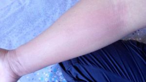 山藥過敏 山藥過敏