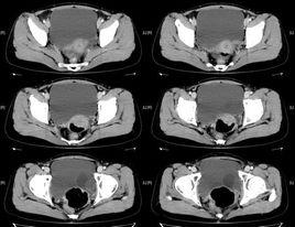 輸尿管囊腫 輸尿管囊腫