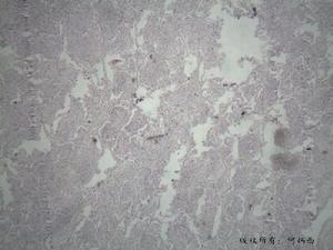 肺炎克雷白桿菌肺炎