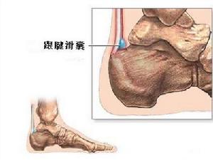 跟腱後滑囊炎