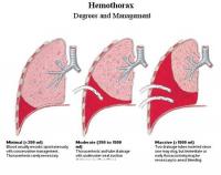 心臟損傷后綜合征 心臟損傷后綜合征