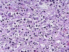 小細胞肺癌 小細胞肺癌