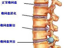 椎間盤膨出 椎間盤膨出