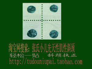 小兒肌性斜頸 小兒肌性斜頸