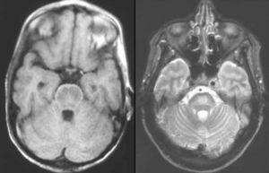 腦橋中央髓鞘溶解症（CPM）的圖像