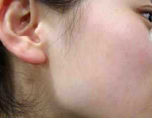 敏感型紅血絲 敏感型紅血絲