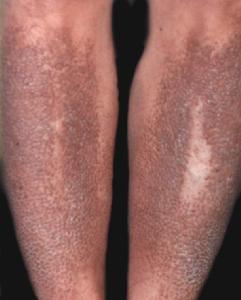 成人Still病 成人Still病