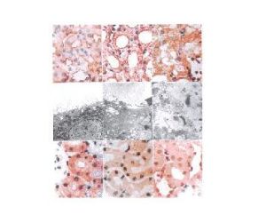 酒精中毒性肌病