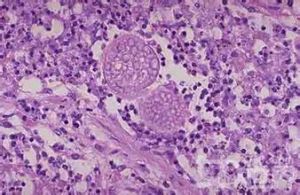 副球孢子菌病 副球孢子菌病