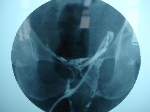 腹膜後感染與膿腫 腹膜後感染與膿腫