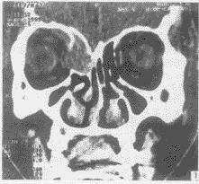 鼻竇粘液囊腫 鼻竇粘液囊腫
