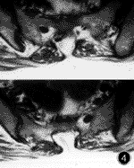 脂肪栓塞綜合徵