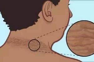 假黑棘皮病 假黑棘皮病