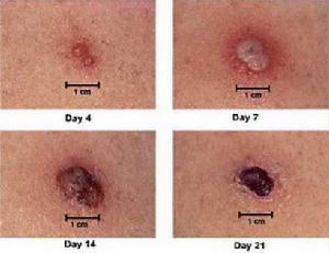 西伯利亞立克次體斑疹熱