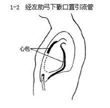 心包切開引流術