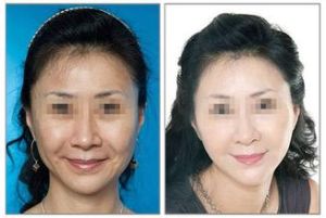 小帽子除皺前後對比圖