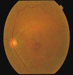 中心性漿液性脈絡膜視網膜病變
