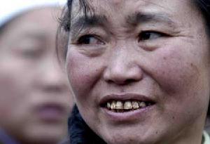 地方性氟中毒 地方性氟中毒