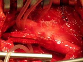 頸動脈內膜剝脫術 頸動脈內膜剝脫術