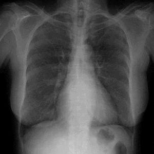 衣原體肺炎 衣原體肺炎
