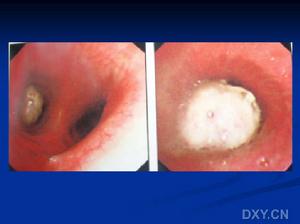 支氣管肺泡灌洗術