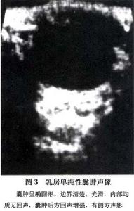 乳房單純囊腫 圖3