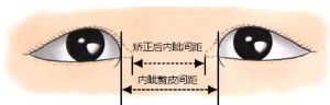 內眼角修復