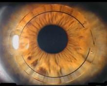 角膜基質環植入後