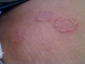 性病的治療 性病的治療