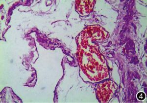 海綿狀淋巴管瘤