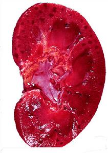 急性腎小球腎炎