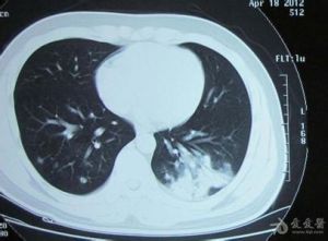 黴菌性肺炎 黴菌性肺炎