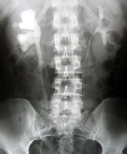 尿路結石 尿路結石