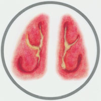 呼吸道炎症 呼吸道炎症