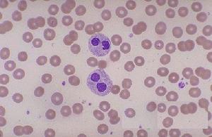 遺傳性凝血因子Ⅶ缺乏