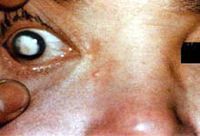 白塞氏病 白塞氏病