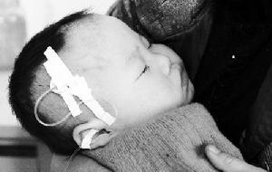 急性苯胺中毒 急性苯胺中毒