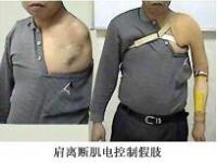 肩離斷假肢 肩離斷假肢