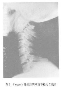 (圖)骨折後期殘留不穩定X線片
