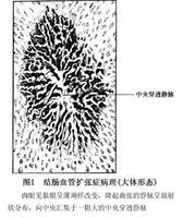 結腸血管擴張症