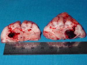 腦外傷所致精神障礙