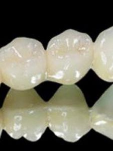 固定義齒 固定義齒